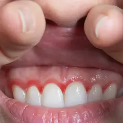 Dientes blancos con encía roja e inflamada alrededor.