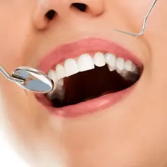 Uśmiechnięte usta z białymi zębami, lustro dentystyczne i sonda. Zabieg kiretaż może pomóc w osiągnięciu takiego efektu.