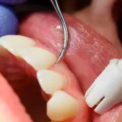 Detalles de un tratamiento dental para como tratar la gingivitis. Se observa un instrumento dental limpiando la línea de las encías.