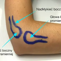 Zaznaczone obszary na łokciu do testu na łokieć tenisisty: nadkłykieć boczny, głowa kości promieniowej, kłykieć boczny kości ramiennej.