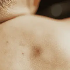 Zbliżenie na skórę z widocznym znamieniem Suttona.