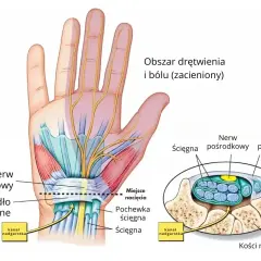 Anatomia dłoni: nerw pośrodkowy, ścięgna i więzadło poprzeczne w kanale nadgarstka. Ilustracja pokazuje obszar drętwienia i bólu.