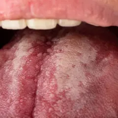 Lengua con manchas rojas y aspecto blanquecino, indicando posibles manchas rojas en la lengua y dolor de garganta.