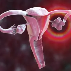 Wchłonięcie torbieli jajnika objawy - nie bagatelizuj tych sygnałów