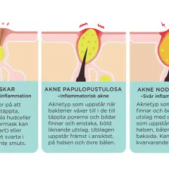 Illustrationer visar olika typer av finnar på huden, från milda pormaskar till svår akne med bölder. Finnar på halsen kan vara ett tecken på inflammatorisk akne.