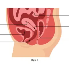 Endometrioza jelita grubego objawy: co musisz wiedzieć o bólu i problemach z wypróżnianiem