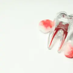 Model zęba z widocznymi kanałami korzeniowymi, otoczony wacikami z krwią, symbolizujący moment, kiedy odpada skrzep po wyrwaniu zęba.