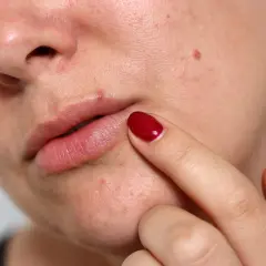 Nahaufnahme von Lippen und Nase mit einigen Mitessern an der Lippe. Eine Hand mit rotem Nagellack berührt sanft die Haut.