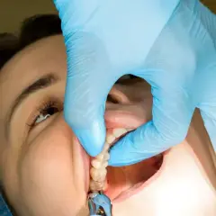 Dentysta w niebieskiej rękawiczce delikatnie wyciąga szwy z ust pacjentki. Czy ściąganie szwów boli?