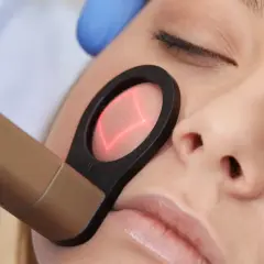 Närbild på ett ansikte som får laserbehandling. En hand med blå handske håller en apparat som riktar en röd laserstråle mot kinden.