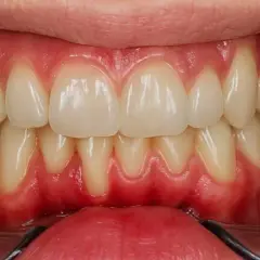 Spuchnięte dziąsło: Szybka ulga, domowe triki i kiedy do dentysty?