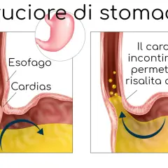 Illustrazione del bruciore di stomaco: il cardias incontinente permette la risalita acida, causando fitte allo stomaco.