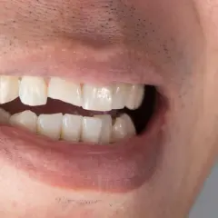 Primo piano di una bocca con un dente scheggiato visibile.