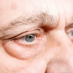 Occhi con evidenti borse sotto, forse un segnale di affaticamento o problemi al fegato.