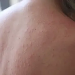 När solen bränner kan huden reagera med små röda prickar och utslag. Här ser du hur soleksem kan se ut på ryggen.