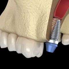 Impianto dentale vicino al seno mascellare. Il rialzo seno mascellare presenta rischi, ma questa immagine mostra la procedura.