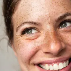 Lachendes Gesicht einer Frau mit Sommersprossen, die den natürlichen Pigment-Haut-Look unterstreichen.