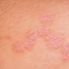 Nahaufnahme von **neurodermitis schuppiger haut**. Rote, erhabene Stellen mit silbrigen Schuppen auf der Haut.