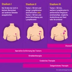 Brustkrebs ist heilbar, je nach Stadium. Die Grafik zeigt Stadien 0-IV und Behandlungsoptionen wie Chemotherapie.