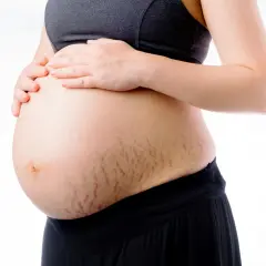 Brzuch kobiety w ciąży z widocznymi rozstępami. Szukasz informacji, co pomaga na rozstępy?