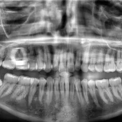 Radiografía panorámica dental. Se observa una muela del juicio impactada, inclinada hacia la mejilla, con posible presión sobre el diente adyacente.