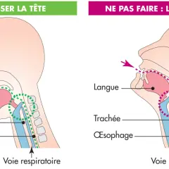 Illustration montrant la bonne (tête baissée) et la mauvaise (tête levée) position pour manger, afin d'éviter la difficulté à avaler et l'obstruction des voies respiratoires.