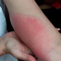 Rumień wędrujący na ramieniu, objaw boreliozy po 15 latach.