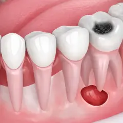 Diente con caries y un quiste odontogénico en la encía.