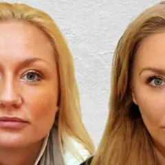 Botoks na bruksizm: Ile jednostek? Koszt, efekty, zabieg