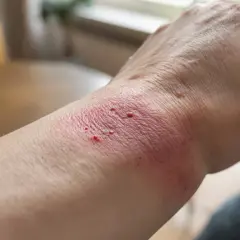 Poignet rouge et irrité, avec des petites cloques, comme une cicatrice qui brûle.