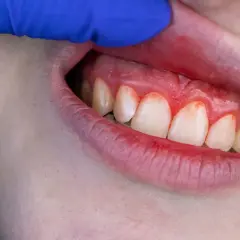 Encías inflamadas y rojas, con signos de sangrado, indicando posible dolor de encías y sangrado.
