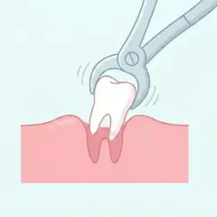 Ilustración de un diente siendo extraído con fórceps. Sí, duele sacarse una muela, pero a veces es necesario.