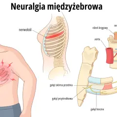 Mężczyzna odczuwa ból mostka, ilustracja pokazuje unerwienie żeber i kręgosłupa, wyjaśniając neuralgię międzyżebrową.