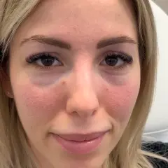 Ansiktsbild av en kvinna med synliga porer och rodnad. Hon har mörka ögonfransar och ljusblont hår. Under ögonen syns en antydan till mörka ringar, vilket kan behandlas med tear trough filler.