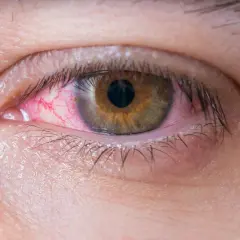 Ojo irritado con venas rojas visibles. Parece el ojo de un niño con ojos rojos por alergia o conjuntivitis.