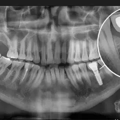 RTG szczęki z widocznym implantem stomatologicznym. Powiększony fragment pokazuje szczegóły augmentacji kości i samego implantu.