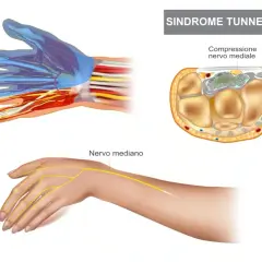 Illustrazione sindrome tunnel carpale: anatomia mano, nervo mediano compresso. Valutare ghiaccio o calore per alleviare il dolore.
