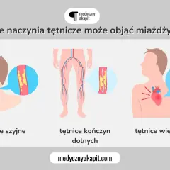 Miażdżyca objawy: zwężone tętnice szyjne, kończyn dolnych i wieńcowe. Ilustracja pokazuje, jak choroba wpływa na naczynia krwionośne.