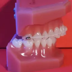 Modelo de dientes con ortodoncia, mostrando cómo los **dientes inclinados hacia afuera** se corrigen.
