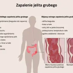 Ilustracja przedstawia objawy zapalenia jelita grubego, w tym wrzodziejące zmiany błony śluzowej.