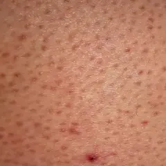 Skóra z licznymi drobnymi grudkami i zaczerwienieniami, charakterystycznymi dla rogowacenia mieszkowego (keratosis pilaris).