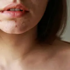 Nahaufnahme von Lippen und Kinn mit Pickeln, die auf Hautveränderungen in den Wechseljahren hindeuten.