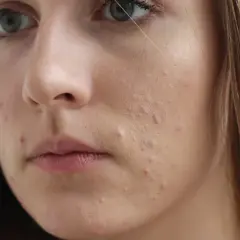 Sudocrem na pryszcze: Działa? Kiedy używać, by nie zaszkodzić?