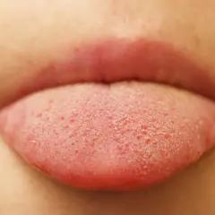 Lingua rossa con piccole bollicine, forse un bambino ha assaggiato qualcosa di nuovo e frizzante!
