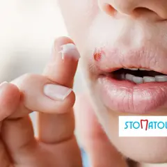 Masz opryszczkę przed dentystą? Sprawdź, kiedy możesz iść!