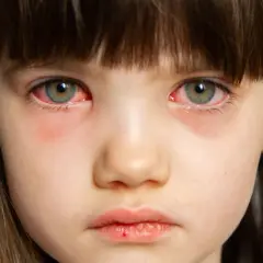 Primer plano de los ojos rojos e irritados de una niña, síntoma común de conjuntivitis en niños.