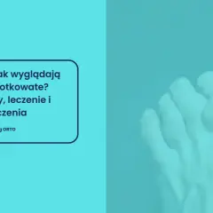 Palce młotkowate: przyczyny, leczenie i ćwiczenia. Widok stopy z zdeformowanymi palcami.