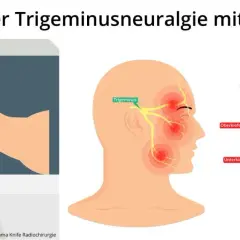 Darstellung der Gamma Knife Bestrahlung zur Behandlung von Trigeminusneuralgie. Grüne Strahlen zielen auf den Trigeminusnerv.