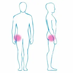 Ilustracje sylwetek ludzkich z zaznaczonym na różowo obszarem bólu biodra.