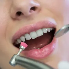 Zabieg fluoryzacji z użyciem szczoteczki i lusterka dentystycznego.